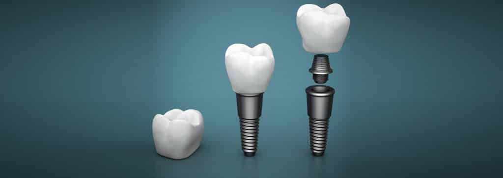 مراحل ایمپلنت یک دندان
