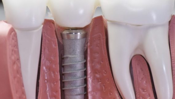 Image result for اندازه و ابعاد ایمپلنت دندان"