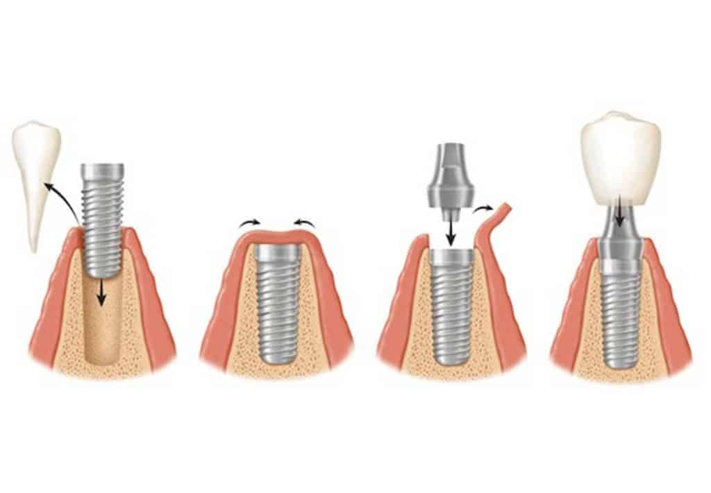 چهار مرحله کاشت دندان