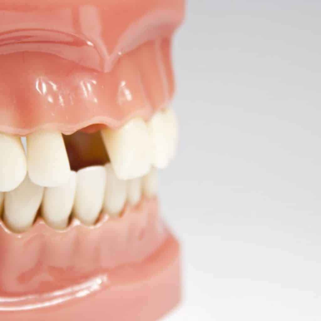 6 مورد از عوارض نداشتن دندان