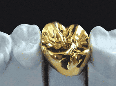 دندان طلا (روکش دندان با آلیاژ طلا)