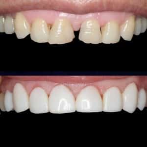 نمونه کامپوزیت دندان و مقایسه قبل و بعد از درمان
