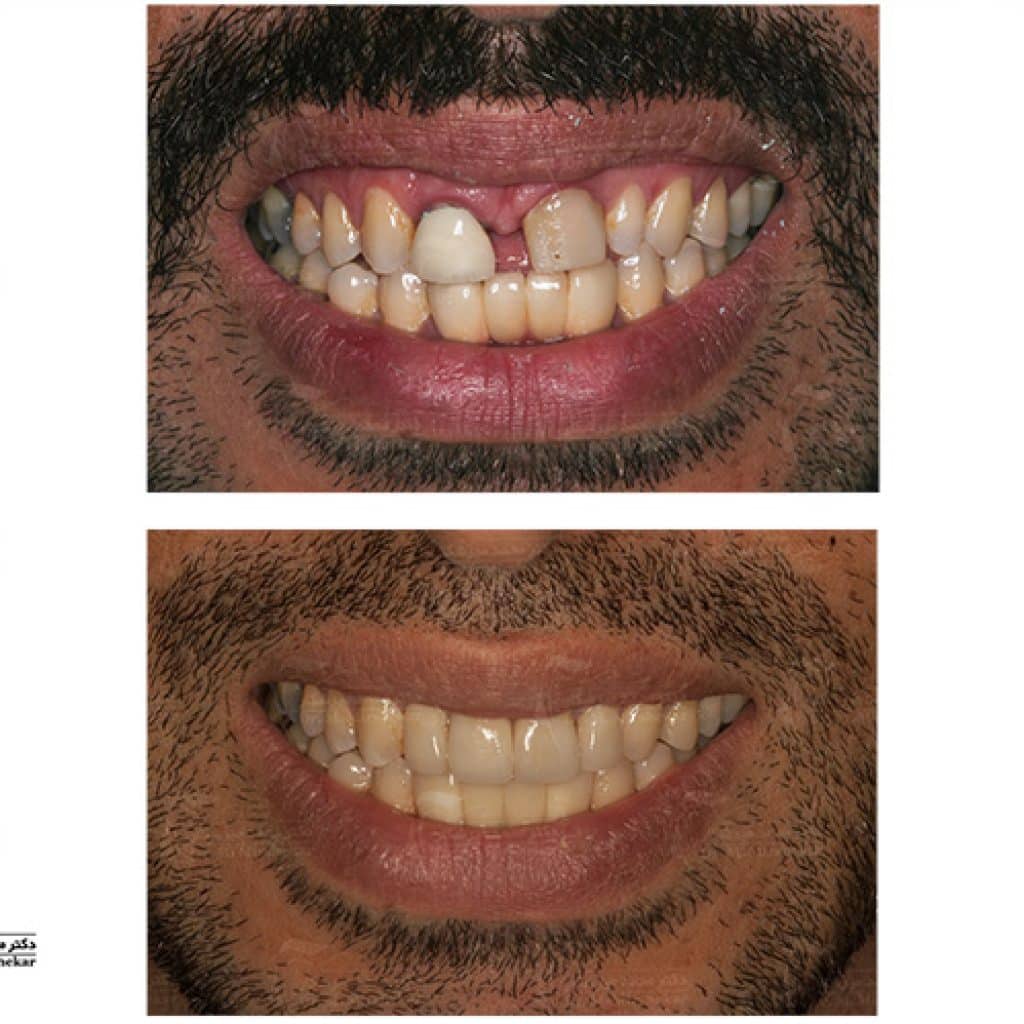 ایمپلنت، لمینیت و افزایش طول تاج دندان با لیزر