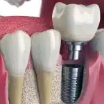 عوارض پس از جراحی ایمپلنت دندان