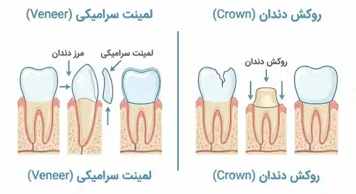 تفاوت لمینت دندان و روکش دندان