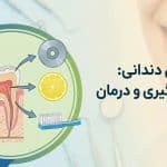 مقاله سایش دندان