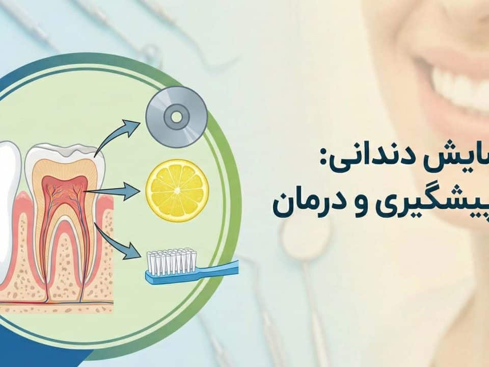 مقاله سایش دندان