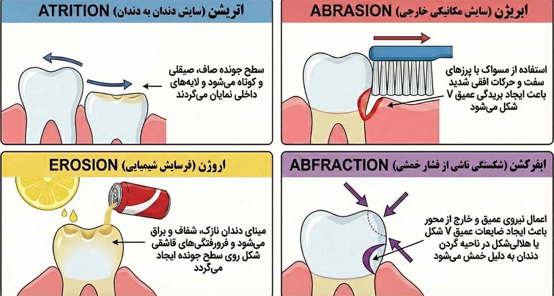 انواع سایش دندان