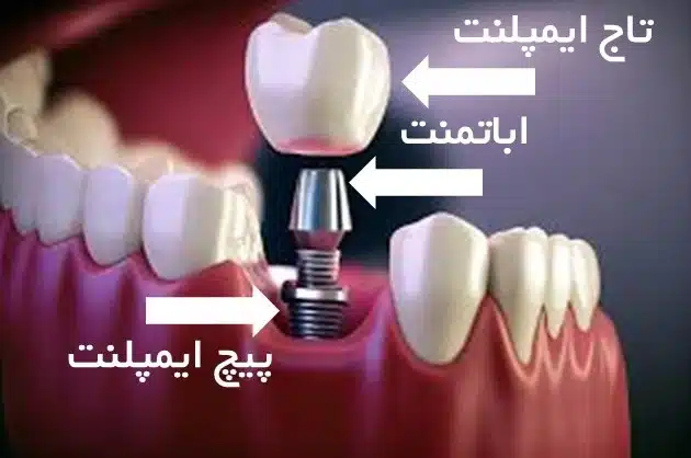 اجزای ایمپلنت دندان