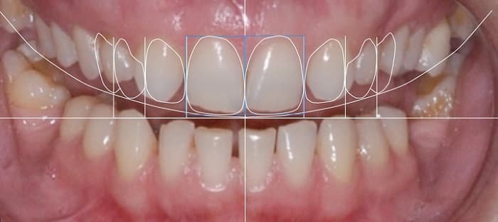 تعیین خط میانه چهره و اصلاح طرح لبخند دندان