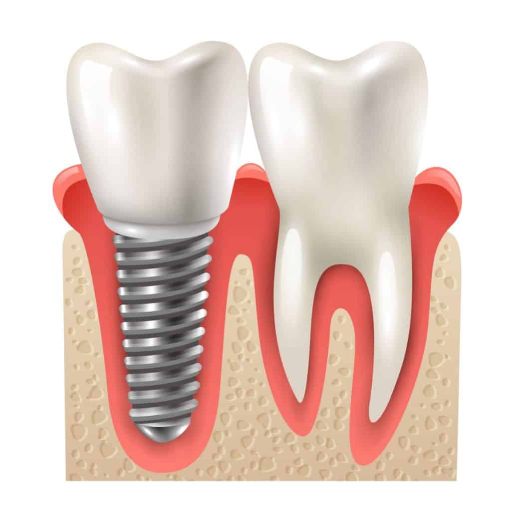 ایمپلنت دندان بدون جراحی و کاشت دندان بدون ایمپلنت