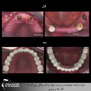 ایمپلنت و روکش PFM