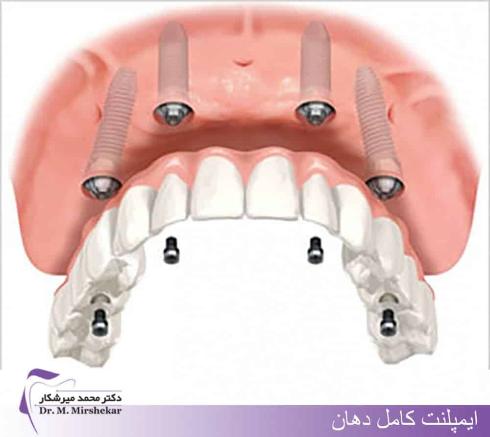 مراحل ایمپلنت تمام دندانها
