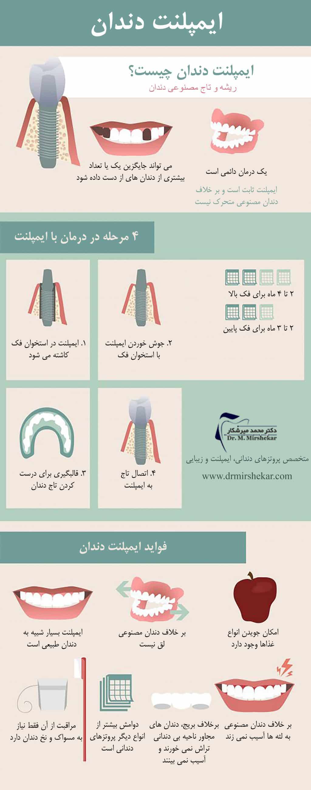 مراحل ایمپلنت دندان و انواع آن
