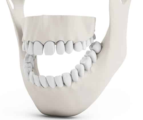 تحلیل استخوان فک در نداشتن دندان