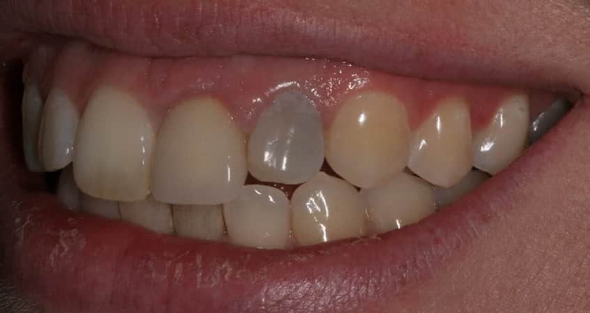 تغییر رنگ روکش دندان و علت سیاه شدن روکش دندان