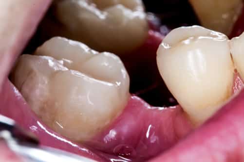 جابجایی دندان ها بعد از کشیدن دندان