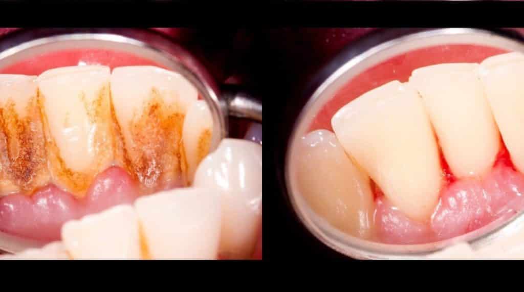 قبل و بعد از جرم گیری دندان