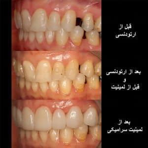 تاثیر درمان ارتودنسی و لمینت برای ردیف کردن دندان ها