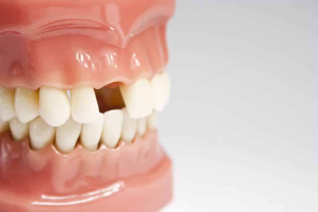 6 مورد از عوارض نداشتن دندان