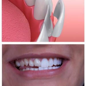 لمینت سرامیکی دندان در اصلاح طرح لبخند