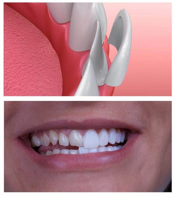 لمینت دندان در اصلاح طرح لبخند