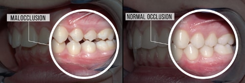 اتصال نامناسب دندان ها بعد از کشیدن دندان
